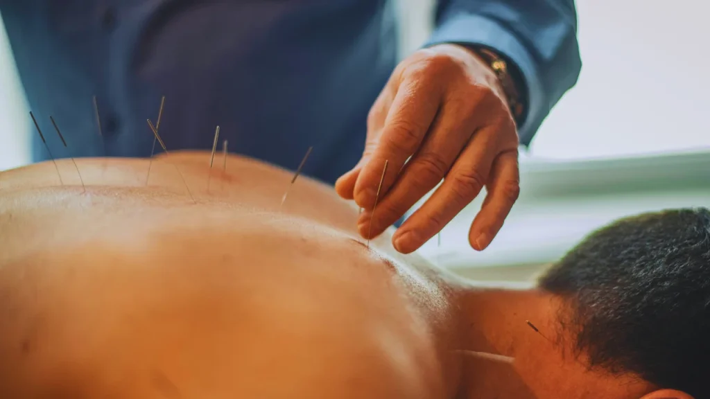 Can Acupuncture Help with Migraines