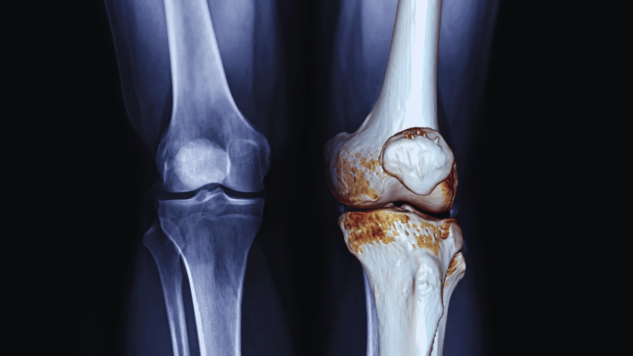 Glucosamine for Arthritis