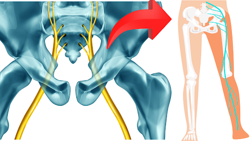 How to get rid of sciatic pain fast