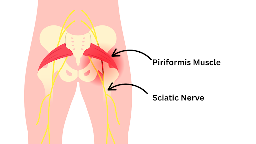 Piriformis Syndrome (Hip Origin)