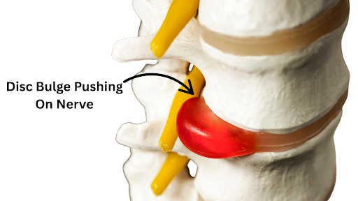 Where Is Your Sciatic Pain Coming From