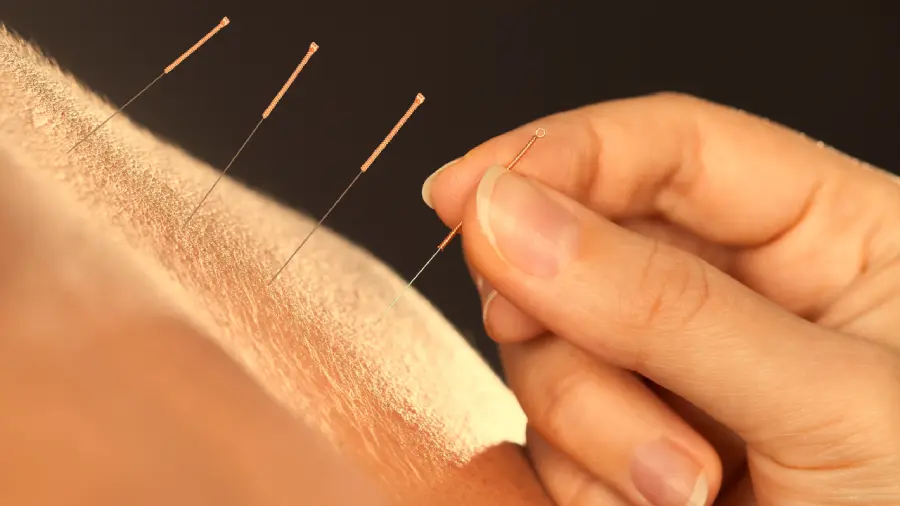 Thumb Arthritis and Acupuncture in Burnaby