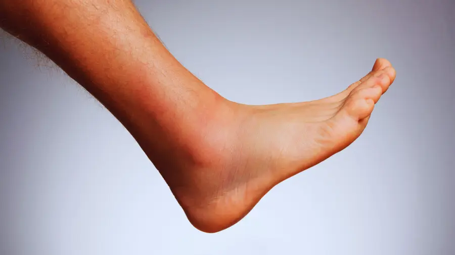 aka Deep Vein Thrombosis or DVT